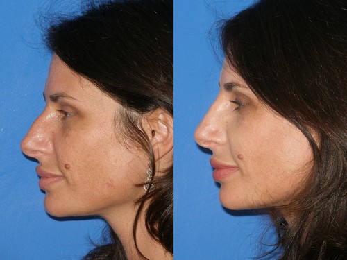 neinvazivní rhinoplastika 6.jpg